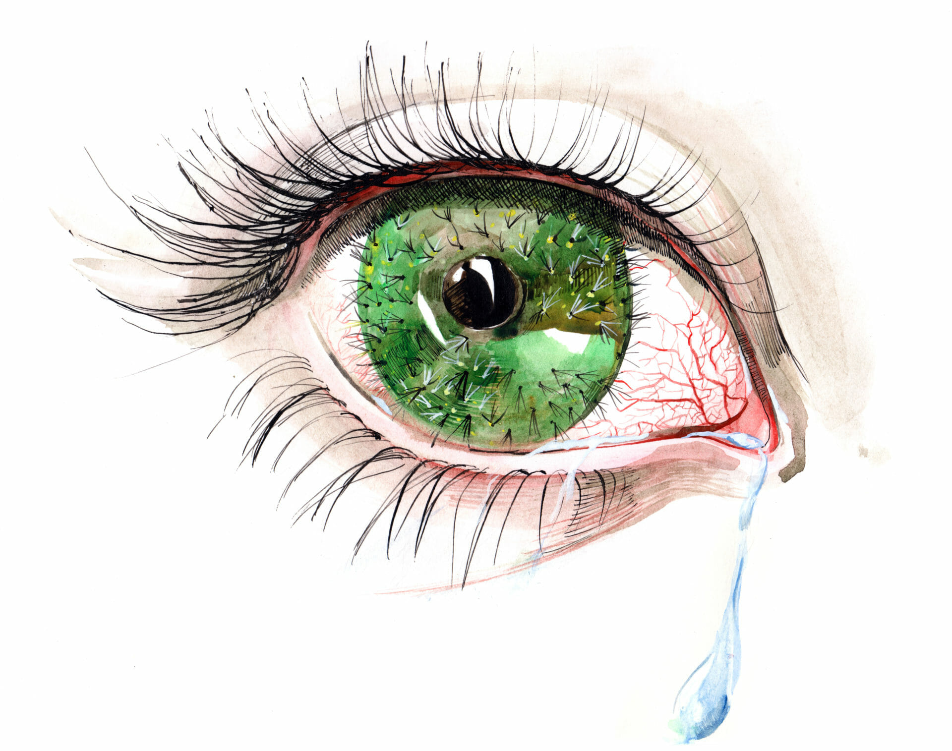 Dry Eye Dry Eye
