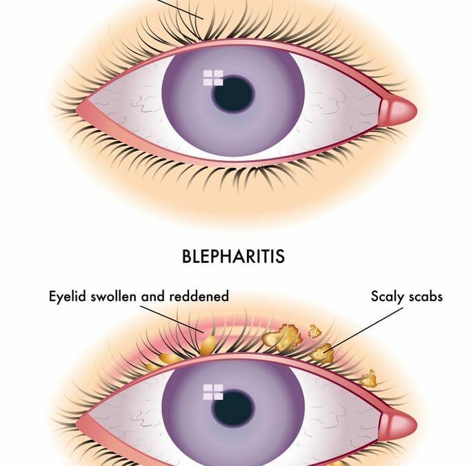 Blepharitis and chalazion: finding relief for dry, painful eyes ... Stue skab