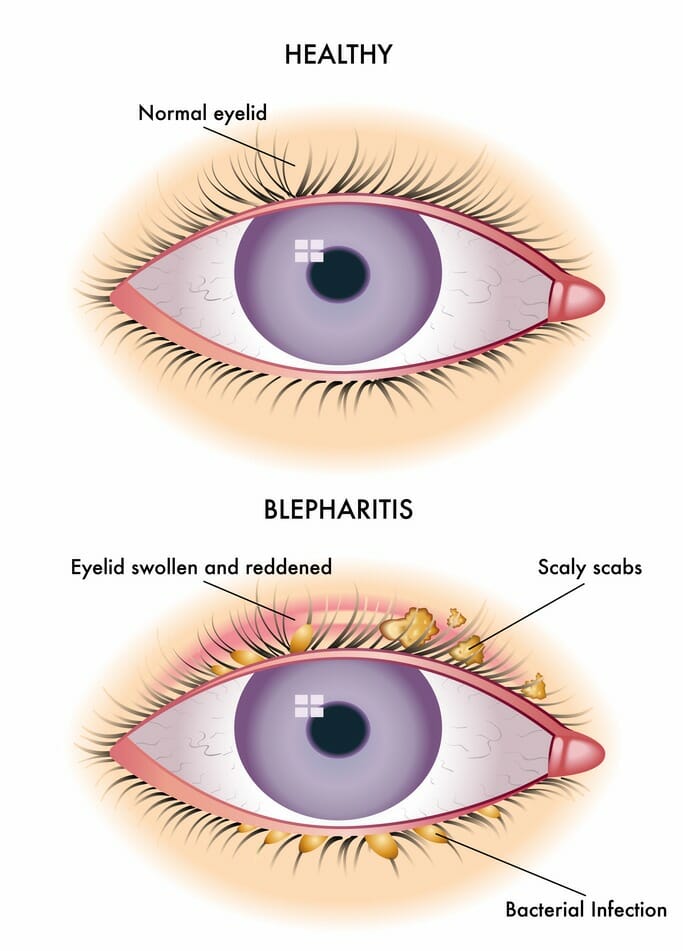 Blepharitis Crusty Eyes Diagram