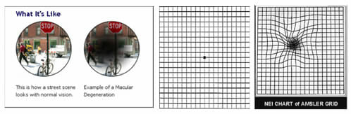 Macular Degeneration