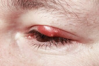 treating a chalazion treating a chalazion