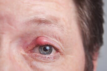 Get Rid Of Chalazion Now. My Personal Story- TheraLife