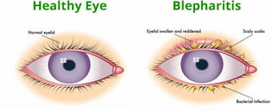 Best Cure for Blepharitis & Dry Eyes Now!