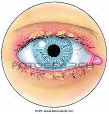 blepharitis causes dry eye syndrome
