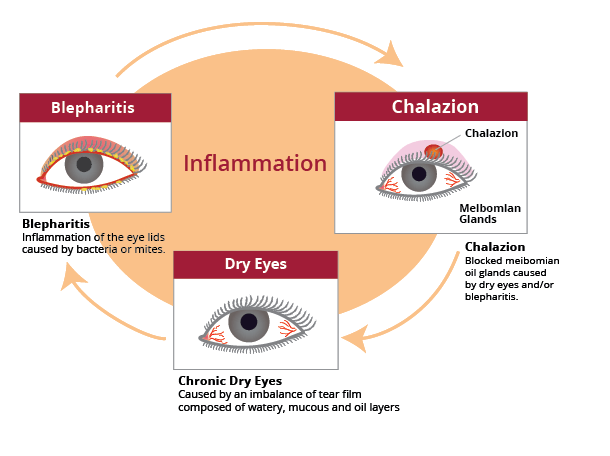 Chalazion Illustration V3