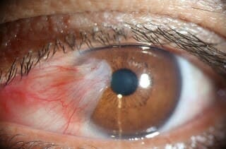 Powerful Dry Eye Treatment for Pinguecula/Pterygium -Surfer’s Eye