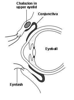 Stop Recurring Chalazion- TheraLife Can Help