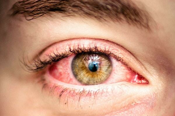 Stop Your Red Irritated Eyes Now With TheraLife