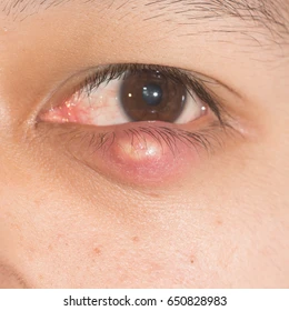 Unveiling the Chalazion Mysteries- Eyelid Bumps