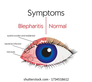 Remarkable Blepharitis Home Treatment