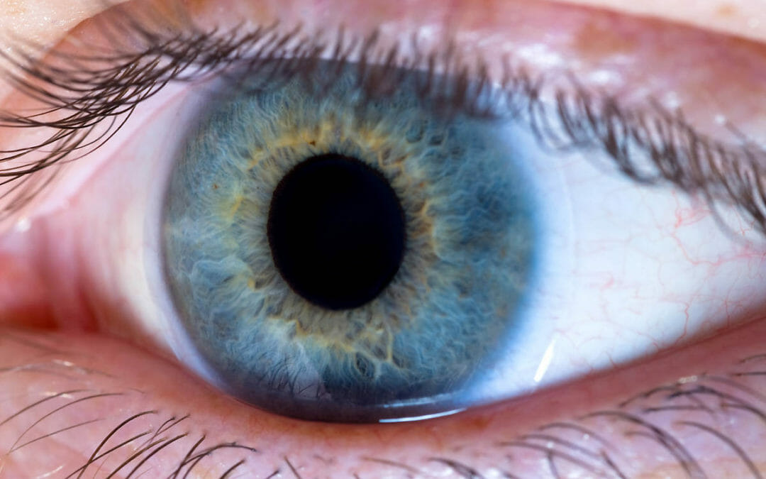 Amazing Infection on eyelid (Blepharitis)