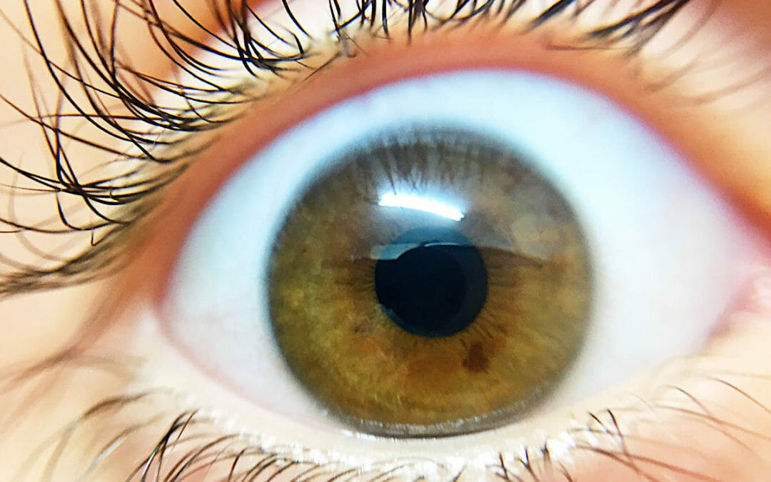 Eye Discharge: White vs. Yellow vs. Green - All About Vision