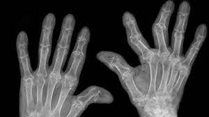 rheumatoid arthritis hands