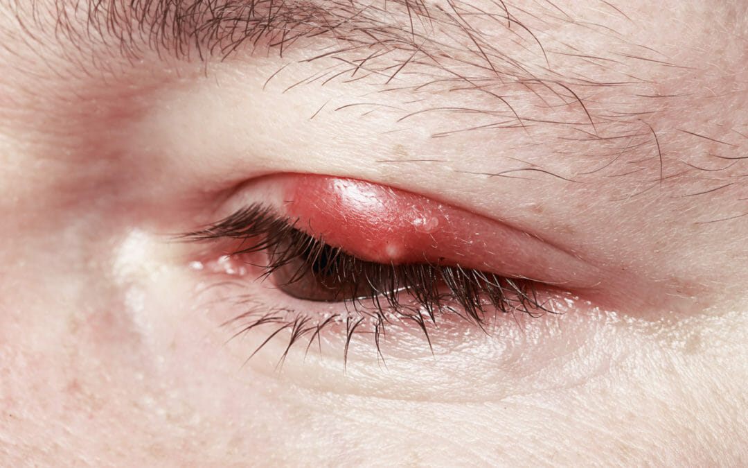 Amazing Stye or Chalazion Eyelid infections