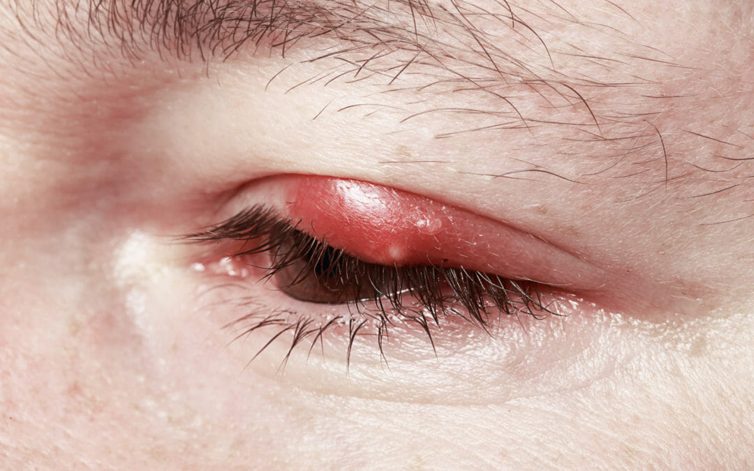 Stye Contagious? Powerful Relief