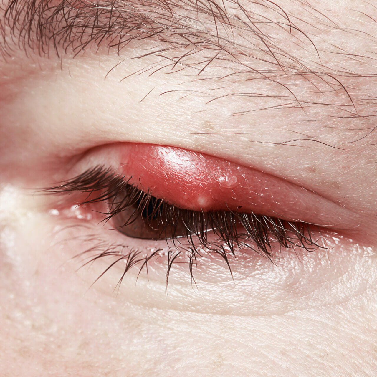 Incredible Hardened Chalazion How To Get Rid Of It With Theralife