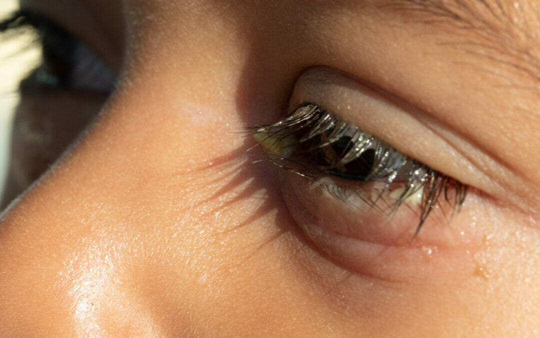 Red Watery Crusty Eyes: How To Soothe Your Eyes And Regain Comfort