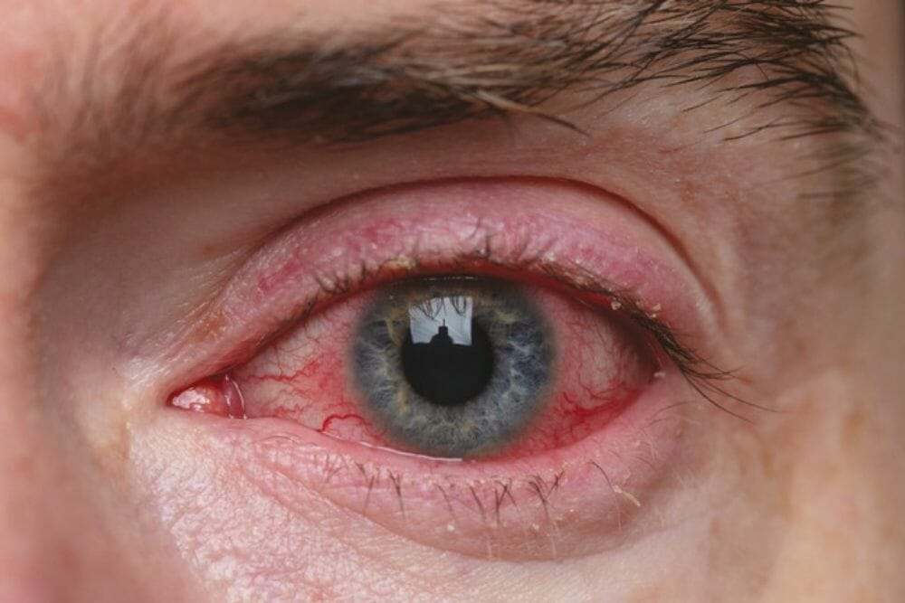Powerful Blepharitis Cure That Works- TheraLife