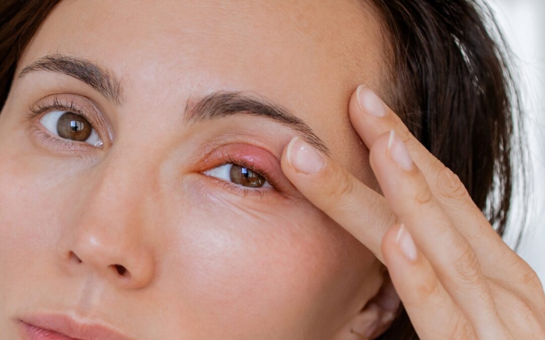 Amazing Chalazion – 11 Home Remedies for Soothing Eyelid Swelling