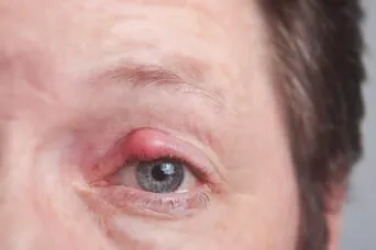 Get Rid Of Chalazion Now. My Personal Story- TheraLife