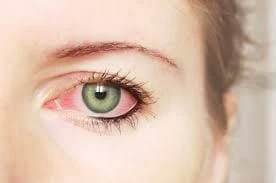 Stop Dry Eye Caused By Glaucoma – Don’t Delay