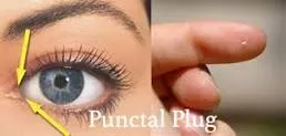 punctal plugs