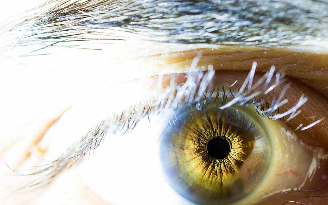 Powerful Relief For Crusty Eyes- With Natural Supplements